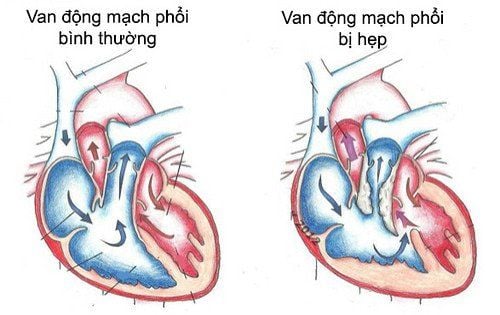 
Hẹp động mạch phổi là bệnh rất thường gặp
