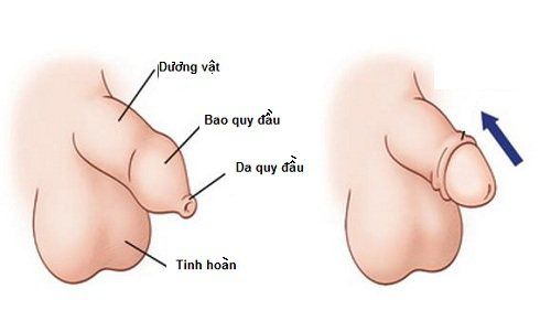 
Bao quy đầu này quá hẹp sẽ gây cản trở quá trình tiểu tiện của bé
