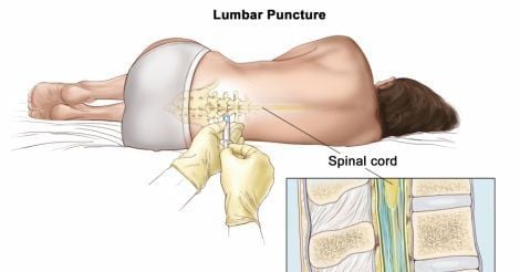 
Chọc dò tủy sống cho phép chẩn đoán một số bệnh lý về não và tủy sống
