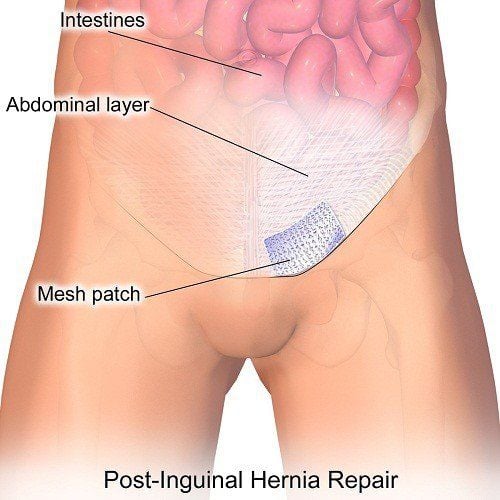 
Thoát vị bẹn nếu không được phẫu thuật sớm sẽ gây nhiều biến chứng nguy hiểm
