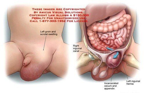 
Hình ảnh khối thoát vụ bẹn gây chèn ép các tổ chức quan trọng của ống bẹn
