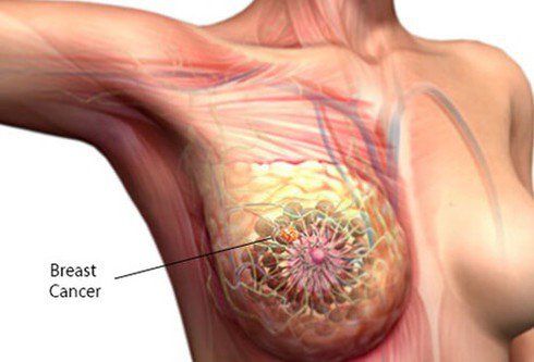 2 commonly used methods in surgery to treat breast cancer