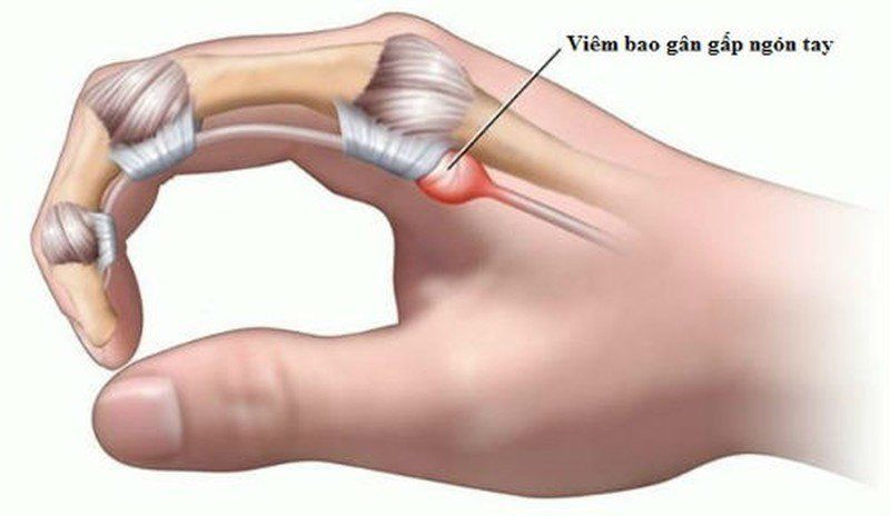 Viêm gân gấp ngón tay: Nguyên nhân, triệu chứng và phương pháp điều trị hiệu quả