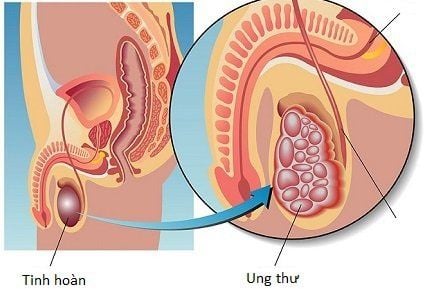 
Ung thư tinh hoàn có thể phát triển ở một hoặc cả hai bên
