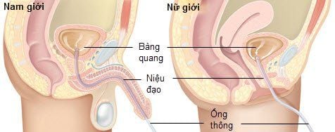 
Hình ảnh mô tả kỹ thuật thông tiểu
