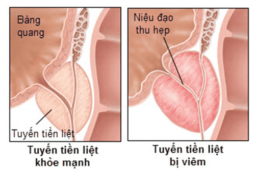 
Viêm tuyến tiền liệt là biến chứng nguy hiểm của bệnh lậu nhưng hiếm gặp
