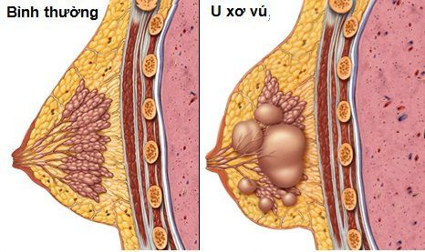 
Estrogen có thể là một trong những nguyên nhân gây ra u xơ vú
