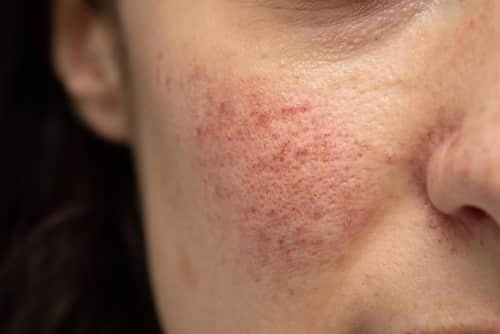 
Nhiễm H. pylori và bệnh rosacea khi điều trị làm giảm đáng kể mức độ nghiêm trọng của rối loạn da liễu
