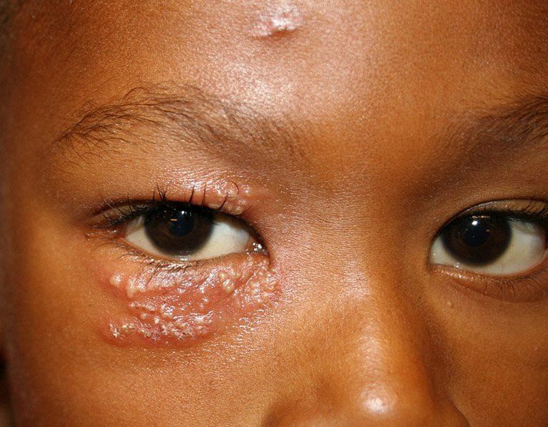 Shingles can be dangerous to the eyes | Vinmec