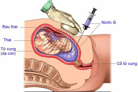 
Chẩn đoán dị tật trước sinh bằng xét nghiệm QF - PCR
