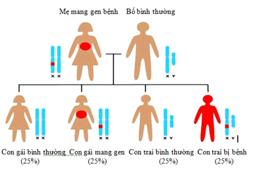 
Hầu hết trong các trường hợp gen lỗi nằm trên nhiễm sắc thể X vậy nên bệnh hầu hết xảy ra ở con trai và di truyền từ mẹ sang con
