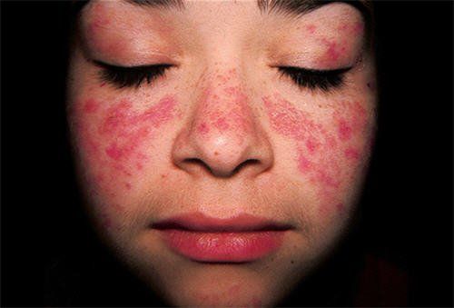 The dangers of lupus erythematosus