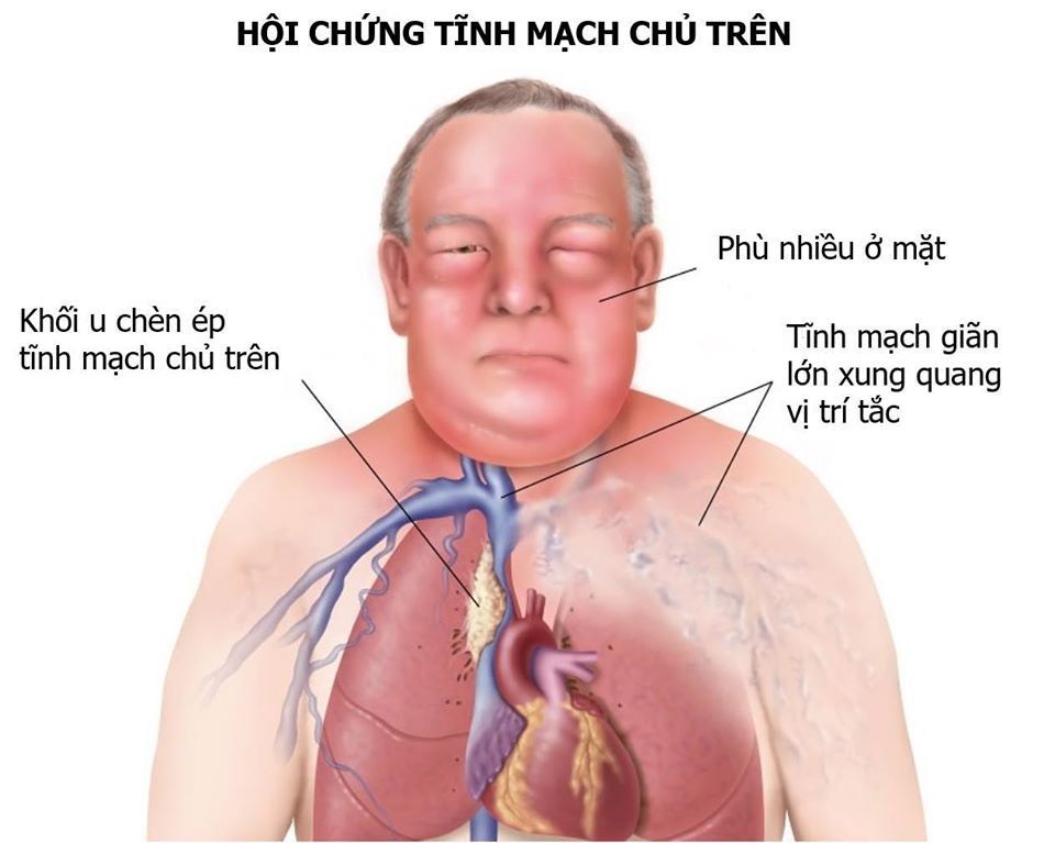 Tĩnh mạch chủ trên: Vai trò quan trọng và các vấn đề liên quan