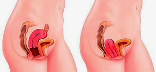 The procedure of combined anesthesia spinal - epidural for genital prolapse surgery