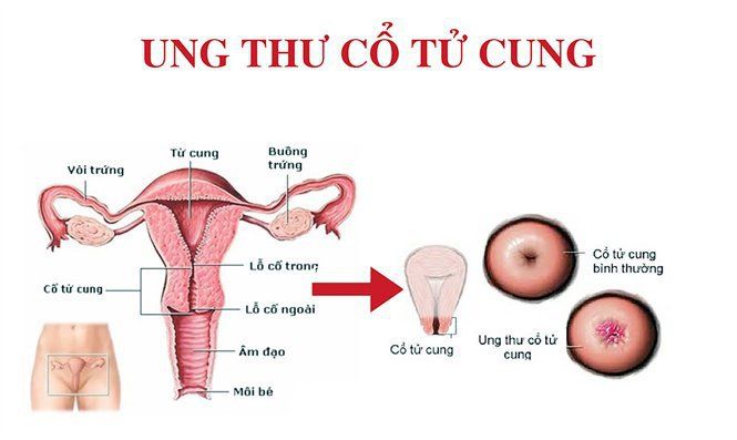 Tầm quan trọng của phát hiện sớm ung thư cổ tử cung