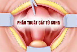 
Hầu hết trong phẫu thuật cấp cứu sản khoa thường có chỉ định cắt tử cung bán phần
