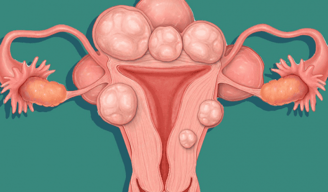 Nhân xơ tử cung là gì có nguy hiểm không? Tìm hiểu nguyên nhân và biện pháp phòng ngừa