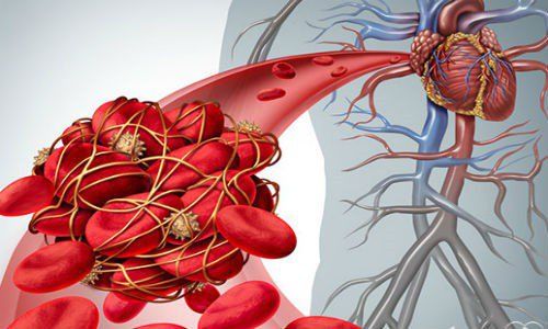 Malignant blood diseases associated with thrombosis