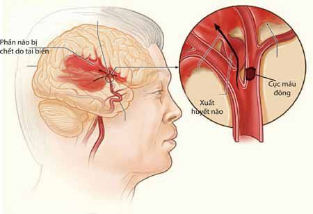 
Tiêu sợi huyết động mạch điều trị nhồi máu não cấp gây xuất huyết não
