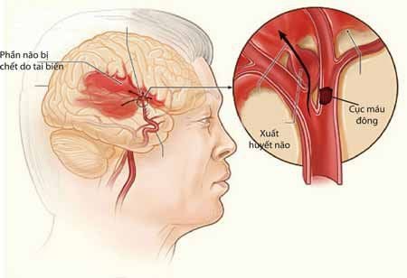 Người mắc xuất huyết não nên điều trị thế nào cho phù hợp?