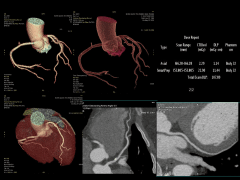 Early detection of coronary heart disease to prevent myocardial infarction