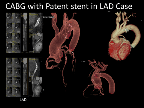 Early detection of coronary heart disease to prevent myocardial infarction