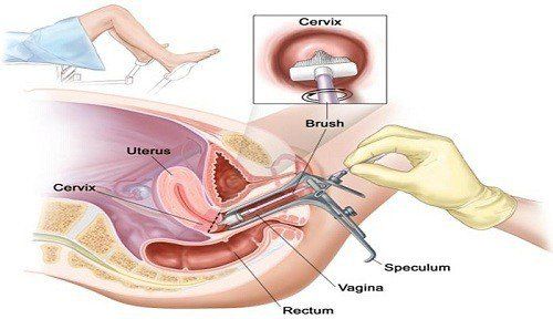 Diagnostic laparoscopy, uterine exploration