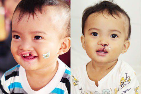 Caring for pediatric patients after cleft palate surgery