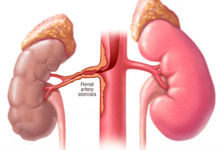 High blood pressure due to narrowing of the renal artery