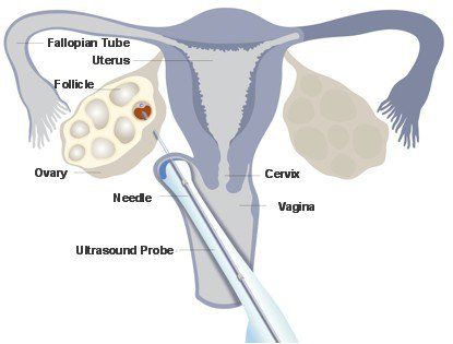 
Sau khi rửa sạch toàn bộ vùng âm đạo, bác sĩ sẽ đưa đầu dò siêu âm vào âm đạo, hướng dãn đường đi cho việc chọc kim
