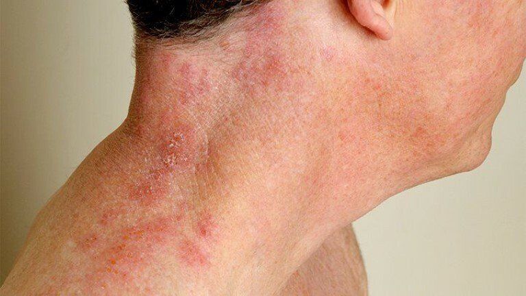 Shingles: When should you go to the doctor?