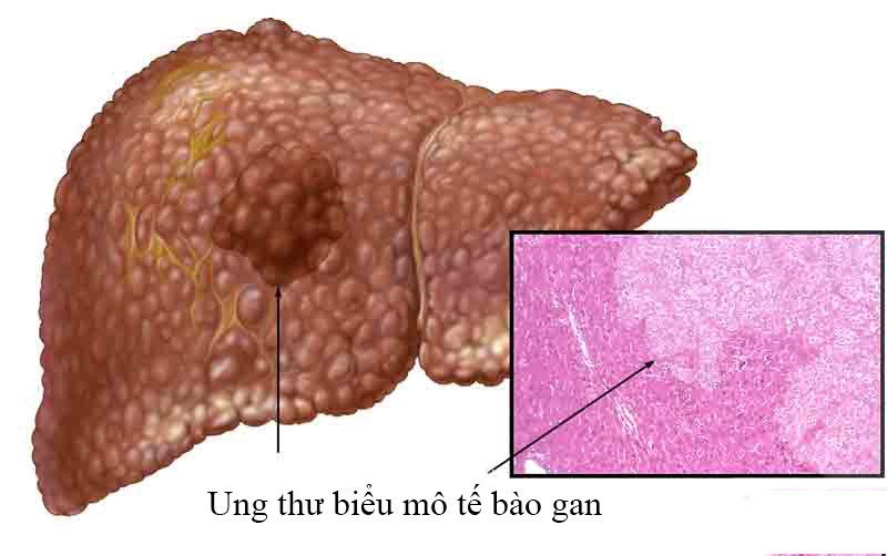 Ung Thư Biểu Mô Tế Bào Gan: Nguyên Nhân, Triệu Chứng và Phương Pháp Điều Trị Hiệu Quả