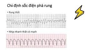 
Chỉ định sốc điện ngoài lồng ngực
