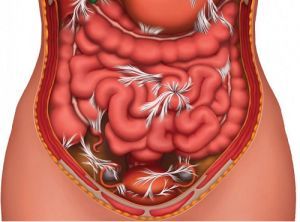 
Bệnh nhân được chỉ định phẫu thuật khi thủng ruột gây viêm phúc mạc
