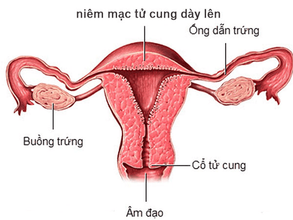 Niêm Mạc Tử Cung Dày 15mm: Nguyên Nhân, Triệu Chứng và Phương Pháp Điều Trị