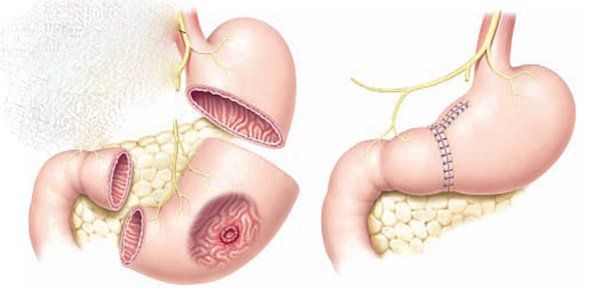 4. Quy trình thực hiện phẫu thuật cắt 2/3 dạ dày