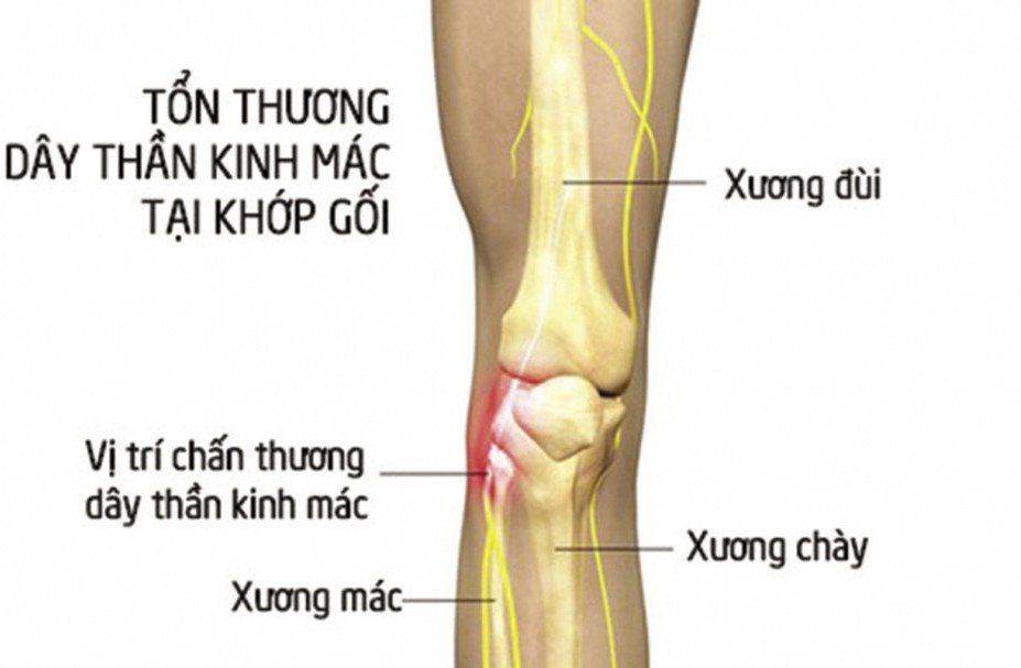 Thần Kinh Chày: Chức Năng, Bệnh Lý và Phương Pháp Điều Trị Hiệu Quả