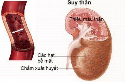 
Chức năng thận kém cần xét nghiệm creatinin trong máu
