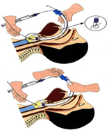 Technique of endotracheal intubation of the nose