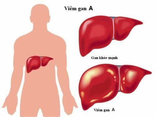 
Viêm gan A do virus
