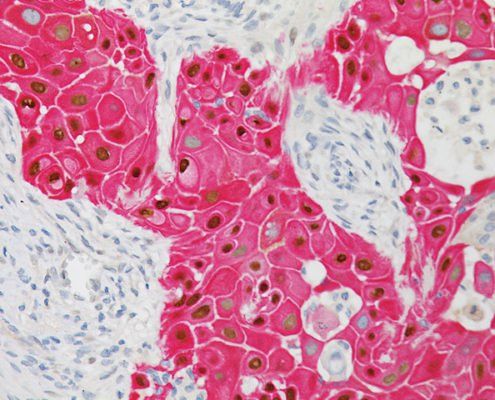 Squamous cell carcinoma: What you need to know