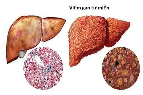 
Các ANA báo hiệu bệnh viêm gan tự nhiễm
