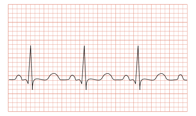 1. Tổng quan về sóng điện tim