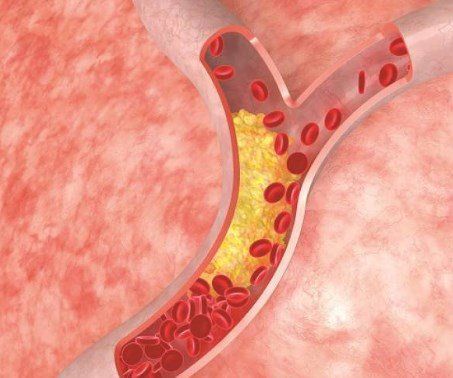 
Rối loạn lipid máu lâu ngày có thể gây hẹp và tắc một số động mạch
