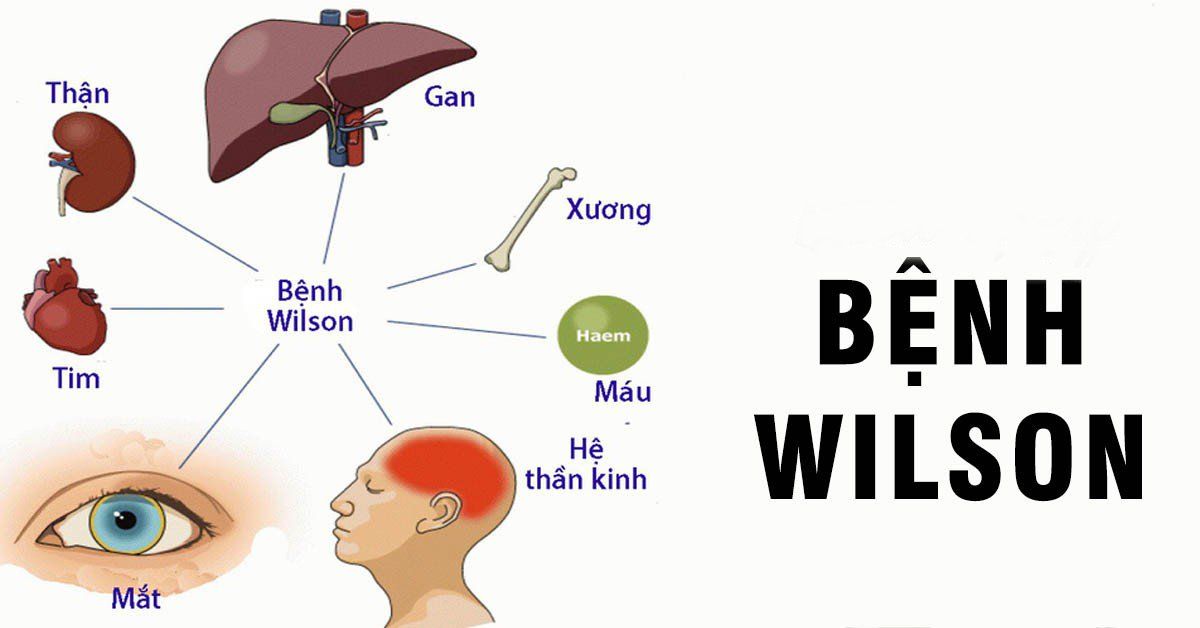 Bệnh Wilson: Triệu Chứng, Điều Trị và Giải Pháp Tốt Nhất