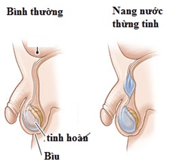 Trẻ 8 tuần có nang thừng tinh kích thước 28.4 ×9mm có sao không?