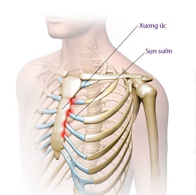 1. Tổng quan về dị tật xương ức lồi