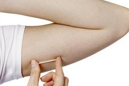 Cấy que tránh thai được 1 năm bị thoái hóa gây teo cơ tay có nên tháo que tránh thai không?