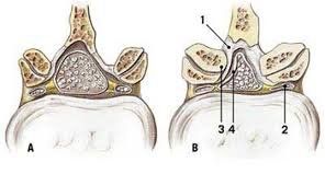 
Hẹp ống sống ở thắt lưng
