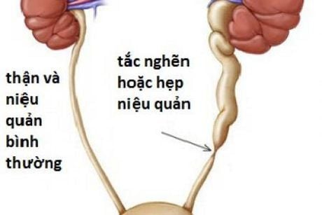 
Thận, niệu quản bình thường và thận, niệu quản bị tắc
